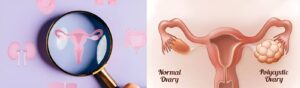 Normal ovary vs PCOS