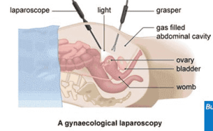 In Gynecological laparoscopy laparoscope is inserted through tiny incision.