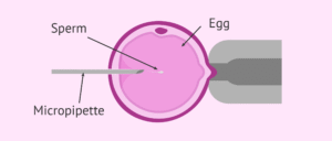 ICSI is a method to treat infertility