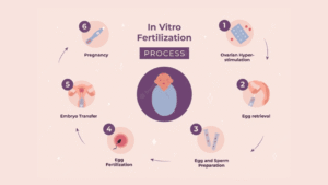 Steps of IVF to treat infertility