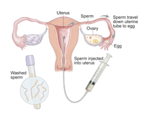 Steps involved in Intrauterine insemination to treat infertility in female.