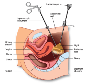 Operative Laparoscopy is a part of Laparoscopic surgery in Gynecology