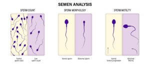 Semen analysis with its type of abnormalities