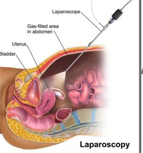 Diagnostic Laperoscopy is a type of Laparoscopic surgery in Gynecology 