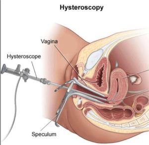 Laparoscopic Hysterotomy is a part of Laparoscopic surgery in Gynecology 