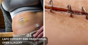 Difference between Incision mark of Laparoscopy vs Open surgery post operation 