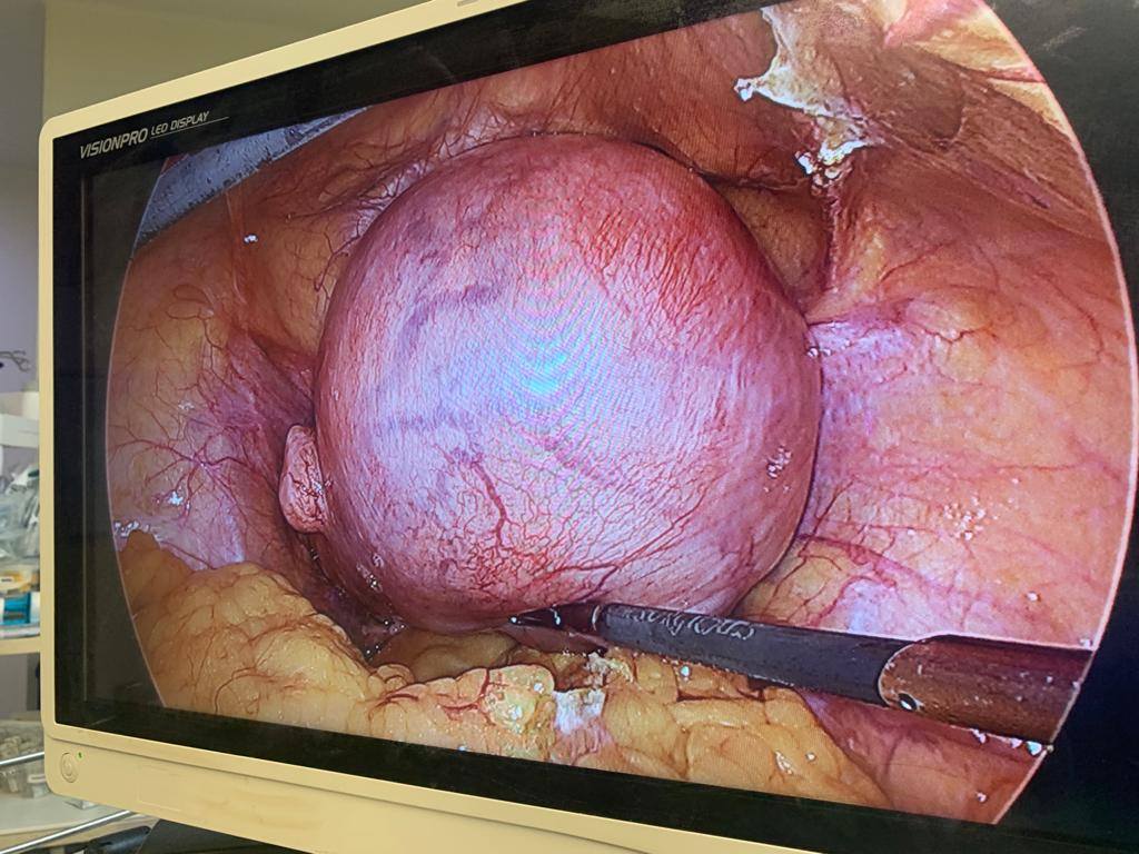 Fibroid removed by Laparoscopic Myomectomy